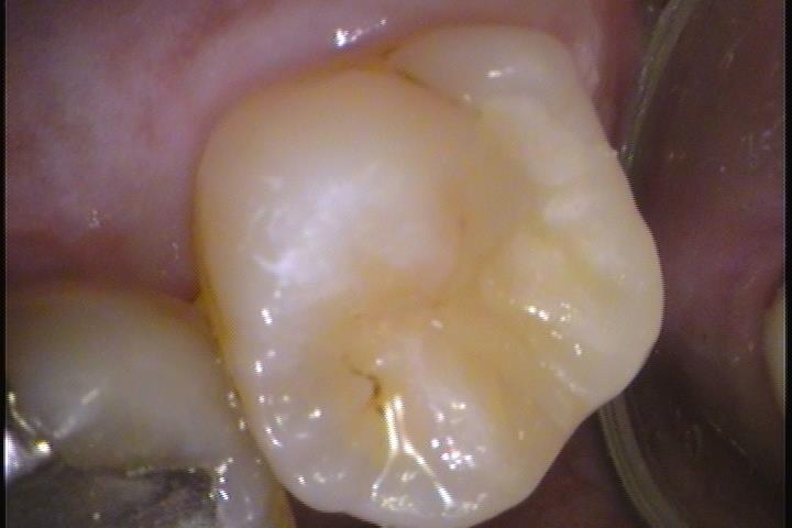 奥歯は虫歯になりやすい😢 ハイブリッドインレーで治療🎵3