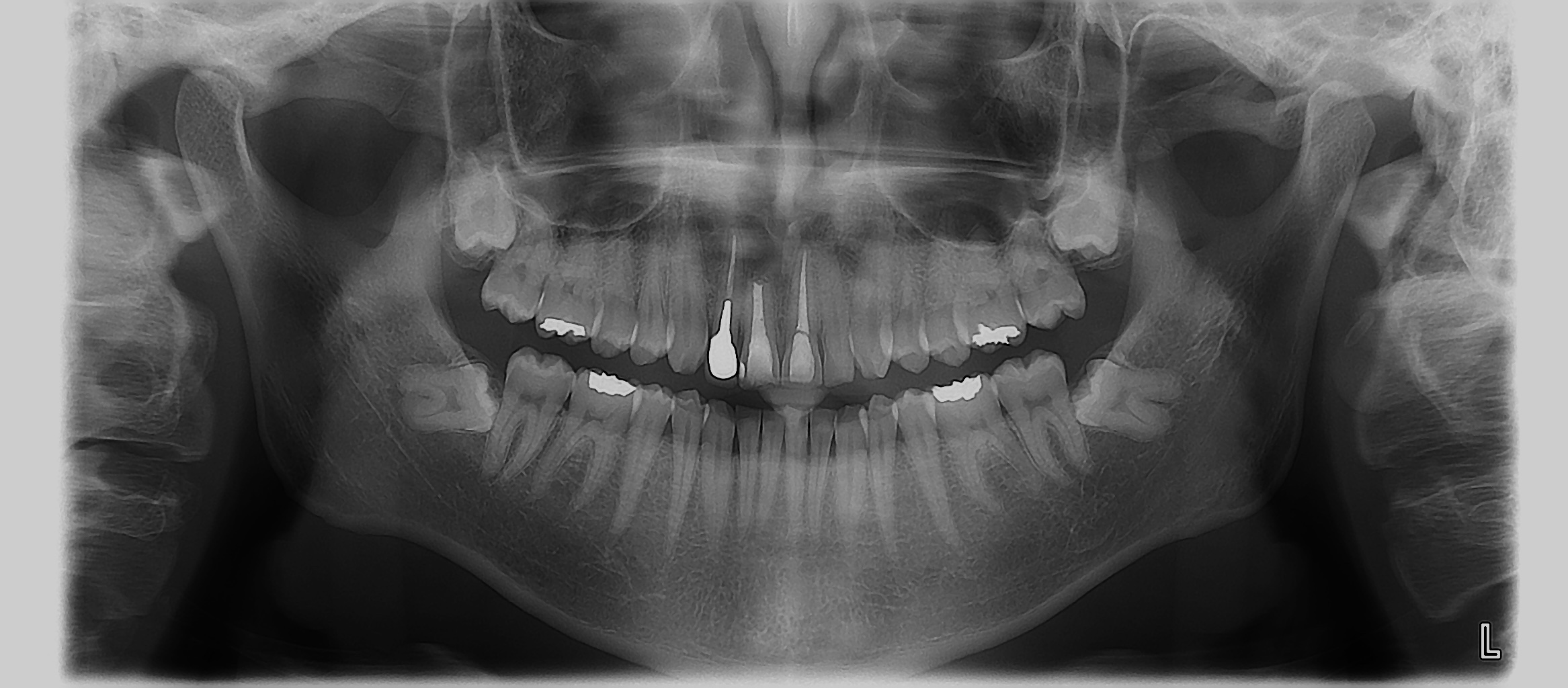 歯根嚢胞の治療２