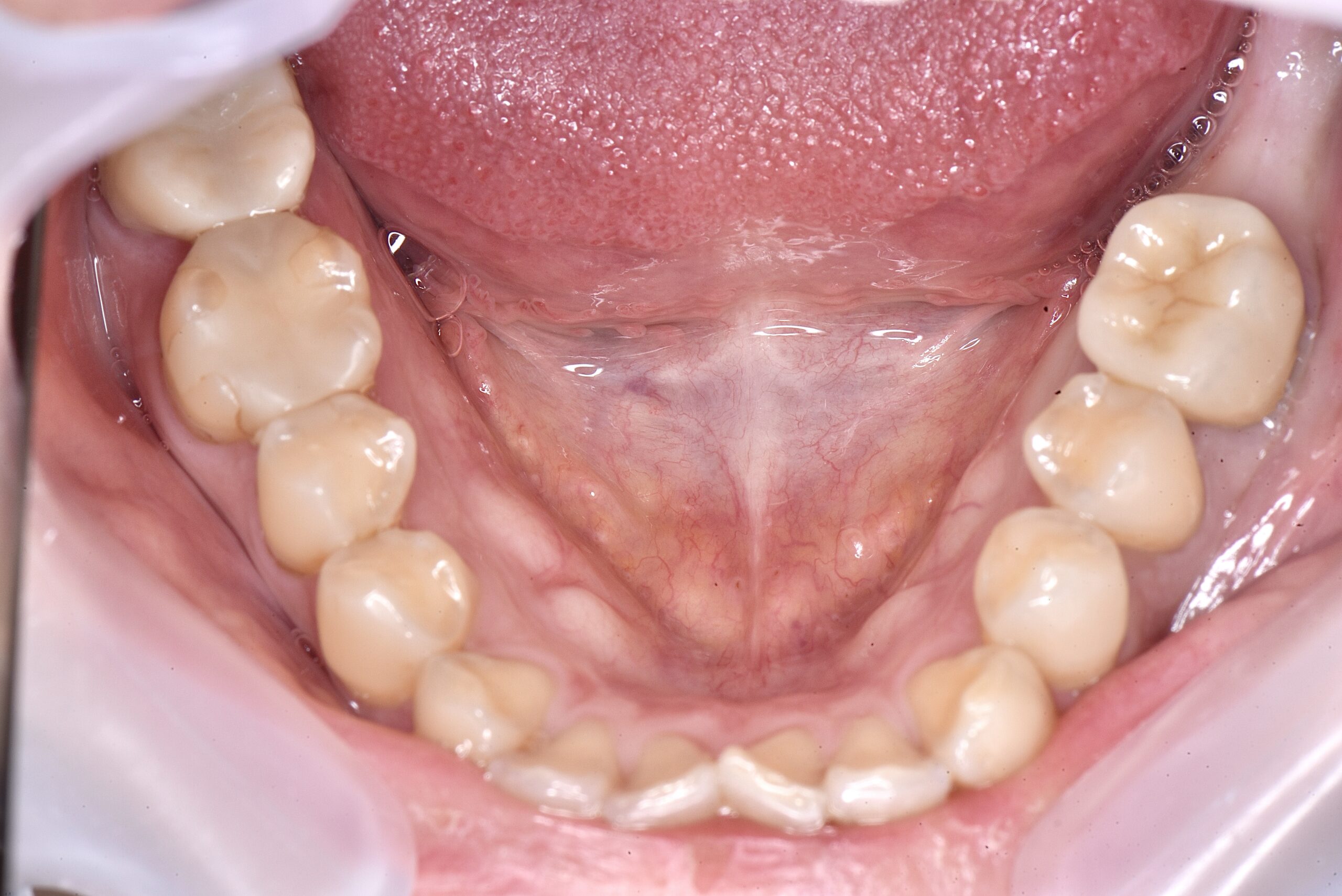 奥歯のインプラント治療😬✨②