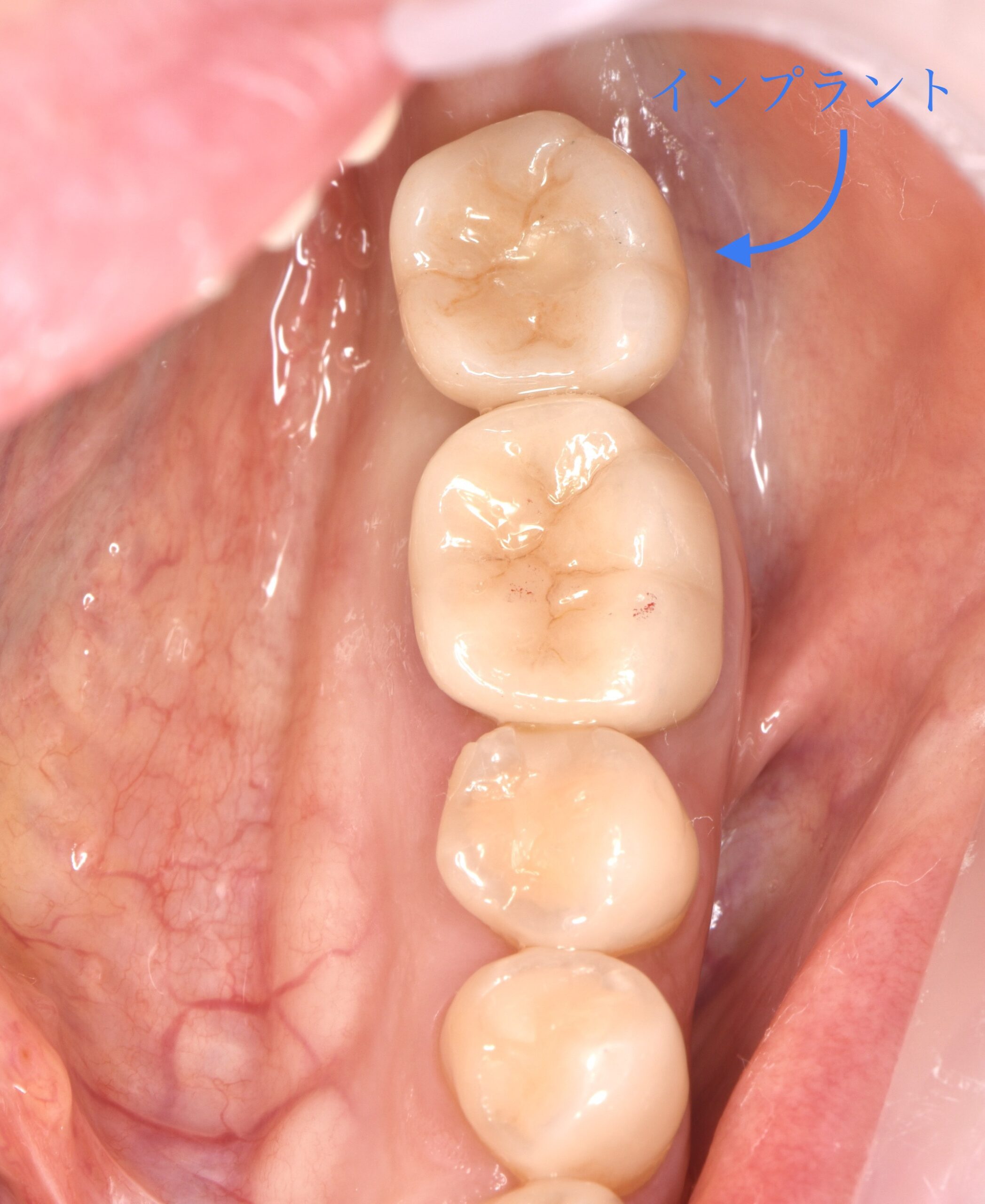 奥歯のインプラント治療😬✨④