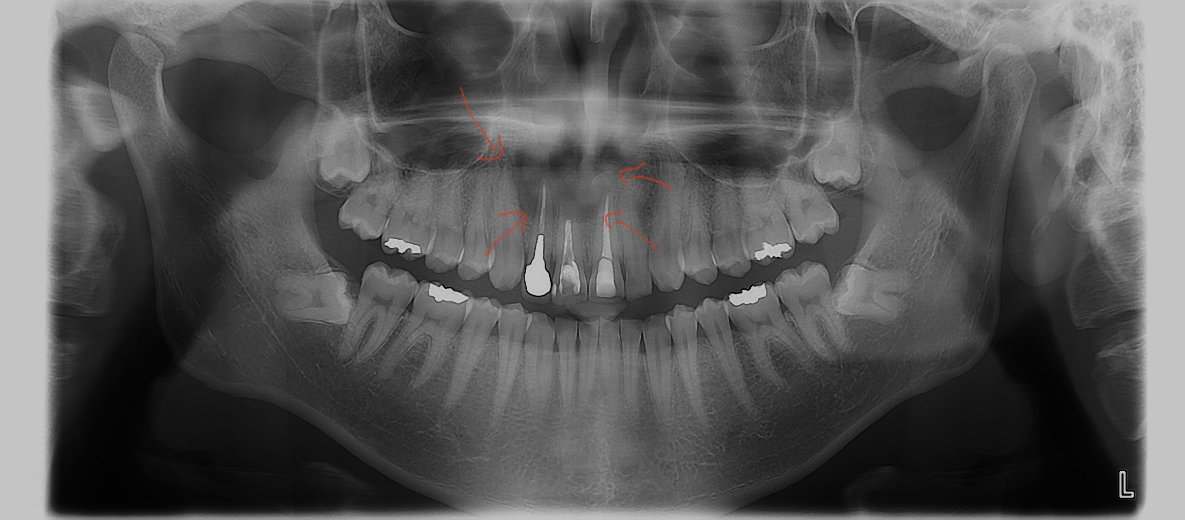 歯根嚢胞の治療
