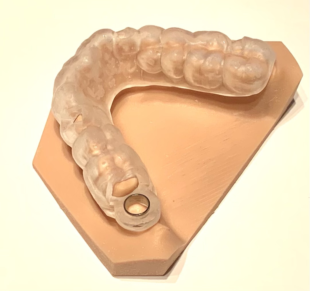 奥歯のインプラント治療😬✨③