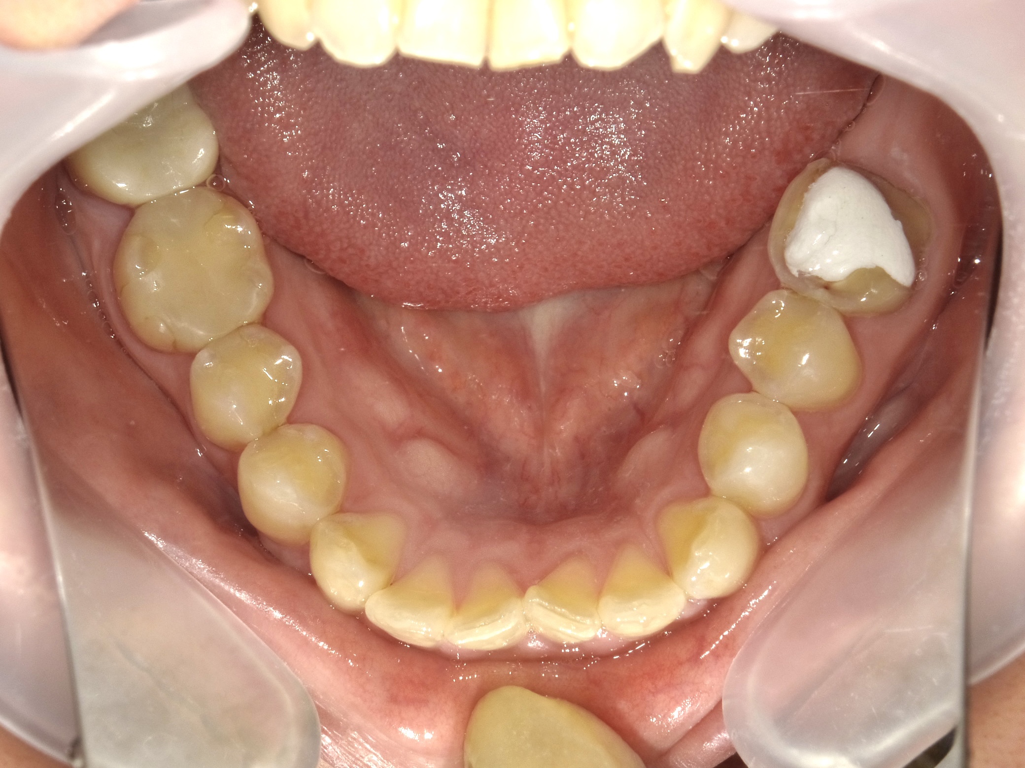 奥歯のインプラント治療😬✨